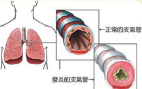支气管炎