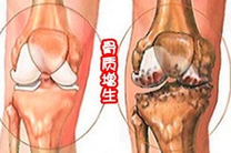 骨质增生