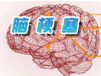 脑梗塞