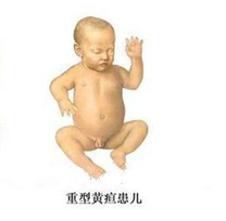 黄疸