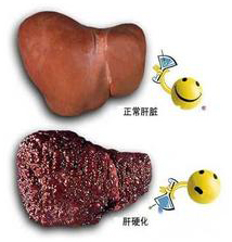 肝硬化