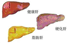肝病