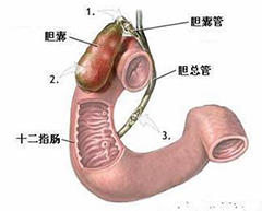 胆囊炎