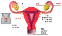 输卵管堵塞