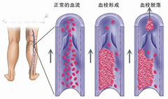 下肢静脉血栓