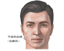白癜风