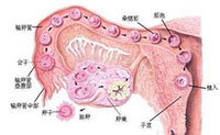 多囊卵巢综合征